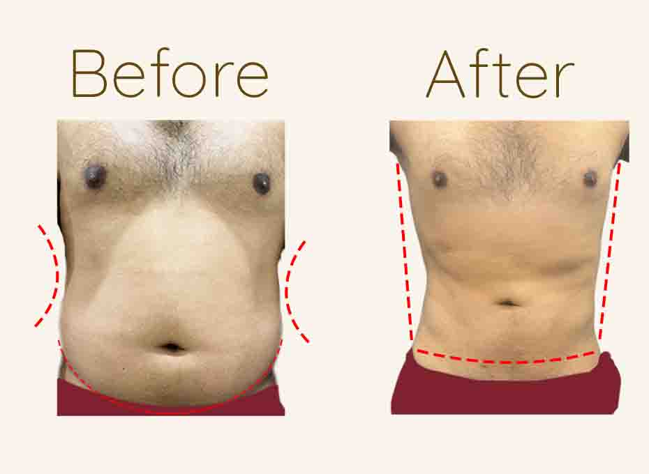 Liposuction-Website-Icon-Before-and-After-3