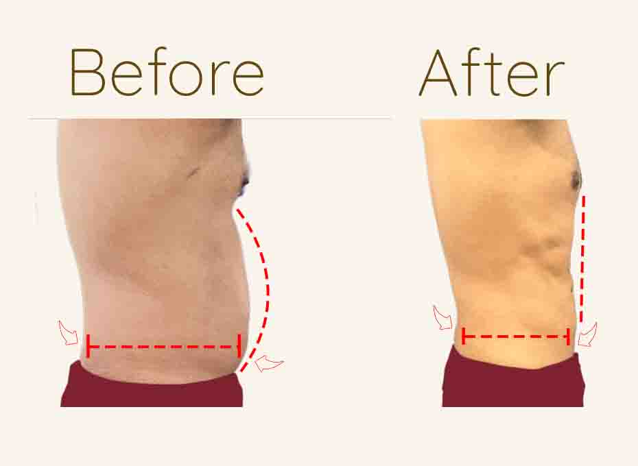 Liposuction-Website-Icon-Before-and-After-4